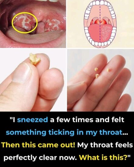 Here’s What You Need to Know About Tonsil Stones