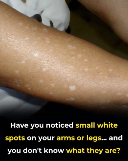 Those Mysterious White Spots on Your Arms and Legs? Here’s What They Really Are—and Why You Likely Don’t Need to Worry