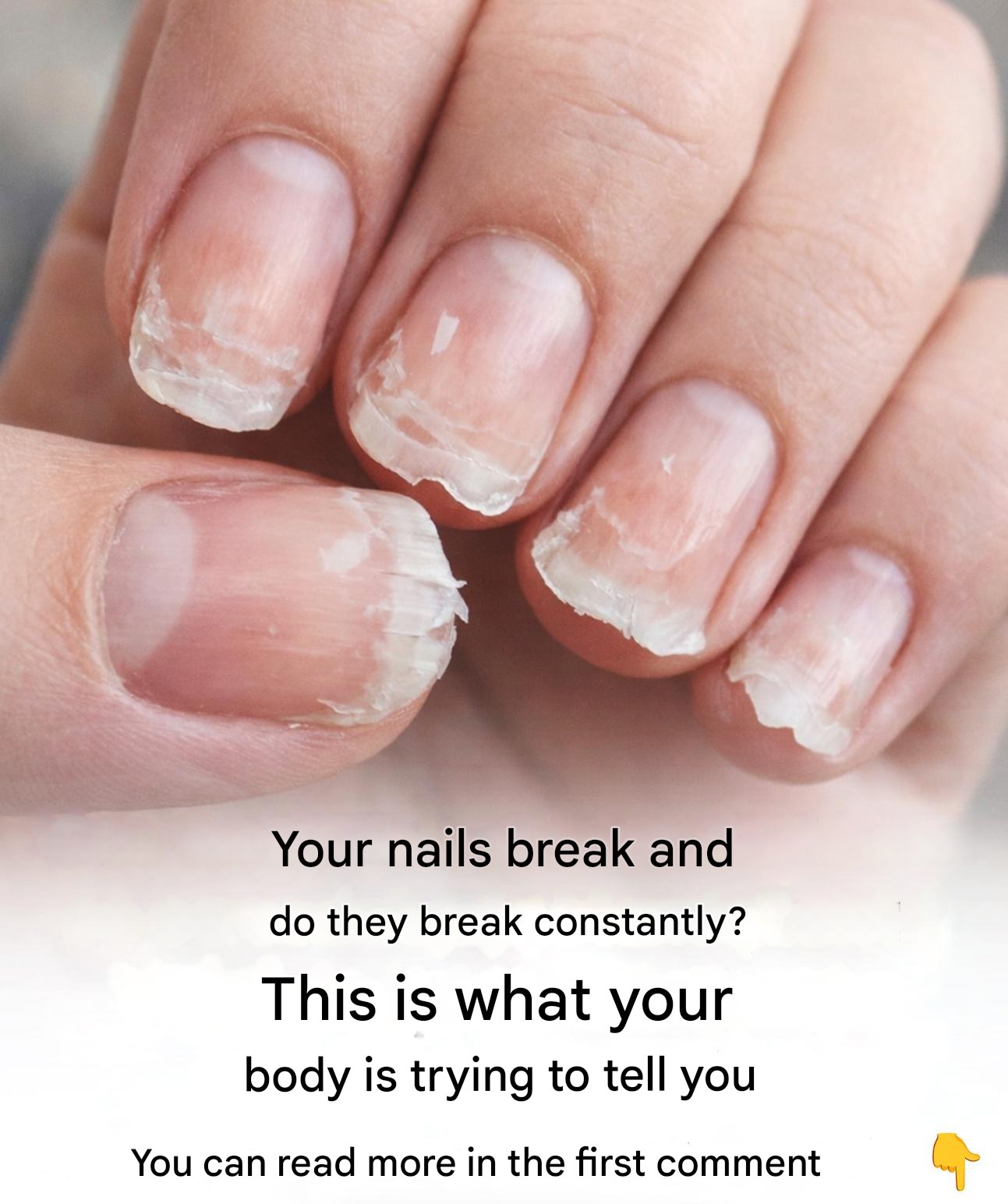 Brittle or fragile nails: what your body is trying to tell you