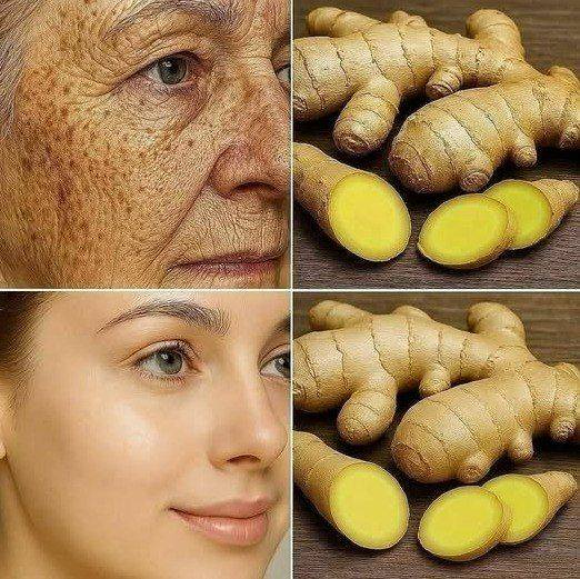 Ginger is 100 times more effective than Botox at eliminating deep wrinkles, freckles, and discoloration.